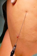 Laserlipo treatment