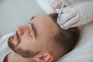 Stem cell injection for hair growth